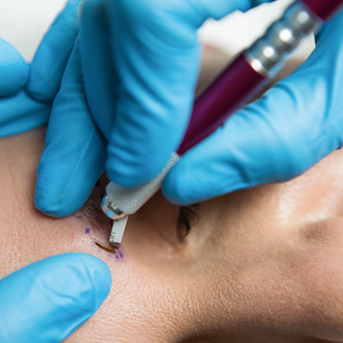 Microblading brow procedure